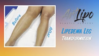 Cankles amp Knees Liposuction  Lipedema Legs  Lipo 360°  Expert Dr Thomas Su [upl. by Paderna]