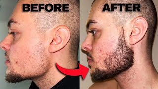 Minoxidil Beard Before And After  2 Months Progress [upl. by Papotto232]