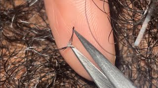 Ingrown and Compound Hair Extractions😍 [upl. by Eigroeg909]