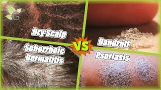 Dry Scalp vs Dandruff vs Seborrheic Dermatitis vs Psoriasis [upl. by Wsan]