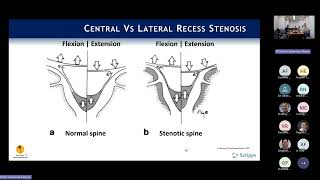 Indications Neurogenic Claudication amp Lateral Recess Stenosis  Phil Fagan MD [upl. by Skardol]