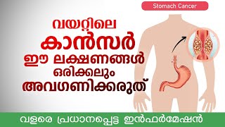 വയറ്റിലെ കാൻസർ ഈ 4 ലക്ഷണങ്ങൾ ഒരിക്കലും അവഗണിക്കരുത്  വളരെ പ്രധാനപ്പെട്ട ഇൻഫർമേഷൻ  Stomach cancer [upl. by Gutow]