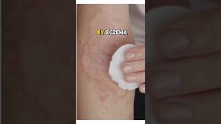 HOW TO MAKE NATURAL CREAM FOR ECZEMA I dont think you´ve heard this recipe before explore reels [upl. by Esilana]