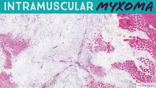 Intramuscular Myxoma 5Minute Pathology Pearls [upl. by Asil]