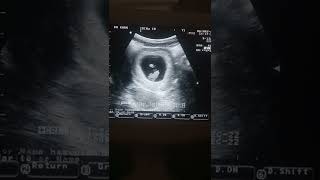 CRL 8 weeks 4 days ultrasound video [upl. by Fiora612]