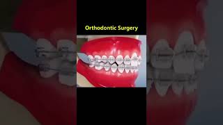 Ortho Treatment open bite العلاج التقويم للعظه المفتوحه 🎖️👌 [upl. by Aelc]