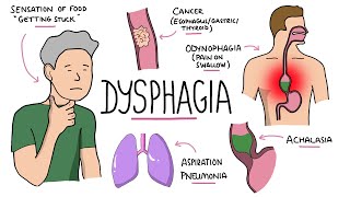 Dysphagia  Oropharyngeal amp Esophageal Dysphagia CausesDifferential Diagnosis Signs Treatment [upl. by Hewitt309]