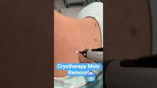 Cryotherapy MOLE REMOVAL Treatment 🥶❄️ [upl. by Jarlath]