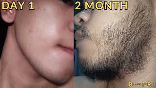 Minoxidil Beard Journey 2 MONTH TRANSFORMATION [upl. by Nileek934]