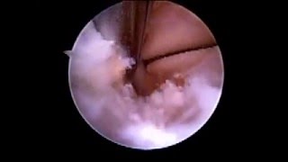 Subtalar Arthroscopy Debridement SFISM [upl. by Assirol]