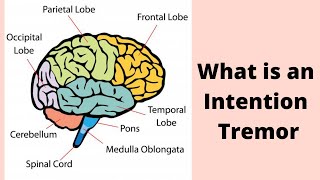 What is an Intention Tremor [upl. by Ahsiram]