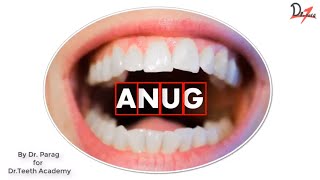 ANUG  Acute necrotizing ulcerative gingivitis [upl. by Rafaela]