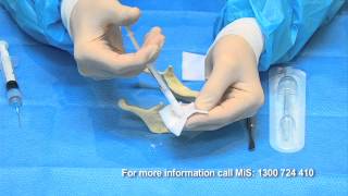 Bone Grafting simplified with BondBone by MIS [upl. by Resee]