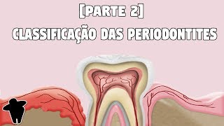 Aula de Classificação das Doenças Periodontais  Concursos Para Dentistas Dentista Estuda 6 PT 2 [upl. by Arte]