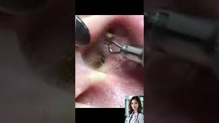 Satisfying Blackheads Removal [upl. by Eidaj194]