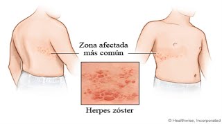 Herpes todo lo que debe saber y quiénes la pueden padecer [upl. by Assilem]