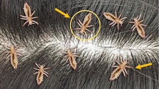 सर की जुएं liceऔर लिखें Nits 1 बार में ख़तम  बालों के लिए  Head Lice amp Nits Removal at home [upl. by Terrill109]