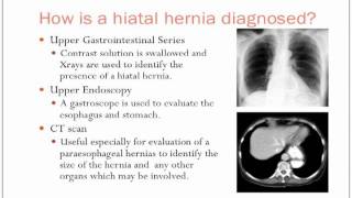 Hiatal Hernias [upl. by Selwin861]