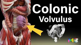 BOWEL OBSTRUCTION Colonic Volvulus [upl. by Jennee611]