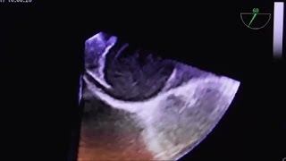 Left atrial thrombus with atypical location Part II [upl. by Anitnemelc734]