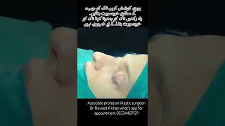 NoseCorrectionDeviatedNoseSurgeryNoseReshapingNoseSurgerybrokennose NoseJob [upl. by Ahsinyd]