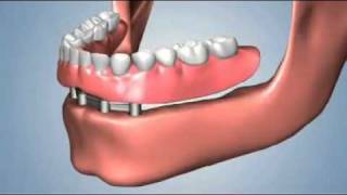 edentulismo completo opciones fija total sobredentaduraflv [upl. by Lough]