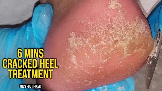 Remove Cracked Heels  So satisfying 6 mins Cracked heel treatment by miss foot fixer [upl. by Aihppa411]