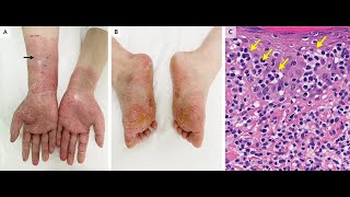 Mycosis fungoides der Handflächen und Fußsohlen [upl. by Elleirb]