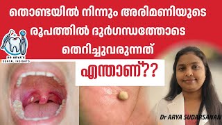 തൊണ്ടയിൽ നിന്നും വരുന്ന അരിമണികൾ എന്താണ് Tonsilolith  tonsil stone draryasdentalinsights [upl. by Alrad]