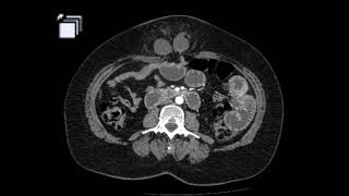 Achados clínicos e tomográficos de uma hérnia intestinal estrangulada na parede abdominal [upl. by Anerb410]