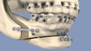 BSSO amp Osseous Genioplasty [upl. by Elwina156]