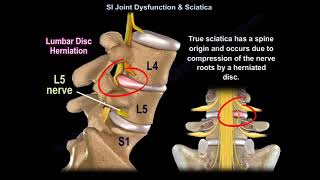 Sacroiliac join dysfunction or Sciatica [upl. by Bower]