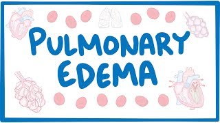 Pulmonary Edema  causes symptoms diagnosis treatment pathology [upl. by Clint]