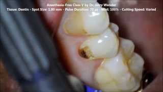 Dr Jerry Wender Class V with Solea Dental Laser [upl. by Zealand]