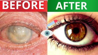 The 1 Remedy for Cataracts  Restore your eyes [upl. by Yevrah671]