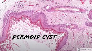 Dermoid Cyst 5Minute Pathology Pearls [upl. by Kcirdnek]