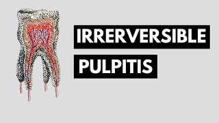 Irreversible pulpitis Introduction Clinical features amp Findings Radiology and Management [upl. by Isak]