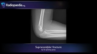 Supracondylar fracture  radiology video tutorial xray [upl. by Llerrut]