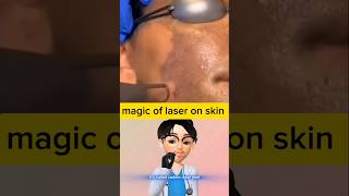 Laser for hyperpigmentation of skin idoctor [upl. by Sieracki]