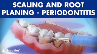 Treatment of periodontal disease  Scaling and root planing  Tartar © [upl. by Asiruam]