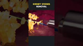 Kidney stone removal surgerypercutaneous nephrolithotomy PCNL [upl. by Aehcsrop581]