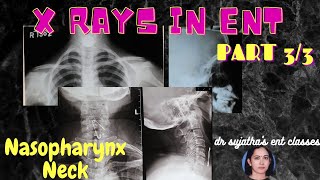 103X ray classes for ENT undergraduates Part 33 xrayclasses clinicalexamination [upl. by Yttisahc]