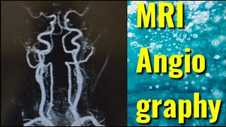 MR Angiography MRA [upl. by Emanuel979]