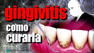 🔵TRATAMIENTO EFECTIVO de la GINGIVITIS y la PERIODONTITIS [upl. by Alak]