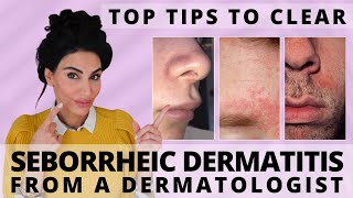 Top Tips to Clear Seborrheic Dermatitis  Dermatologist Deep Dive [upl. by Olraced37]