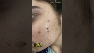 Mole Removal  Laser Mole Removal  how to remove moles from face AlShifa Future Hospital [upl. by Genet735]