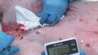 Bioinspired Hemostatic Strategy via Pulse Ejections for Severe Bleeding Wounds Movie 9 [upl. by Dopp]