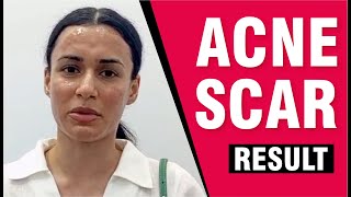 Testimonials Effective Treatments for Acne Scars and Pigmentation Sakhiya Skin Clinic Review [upl. by Trefler589]