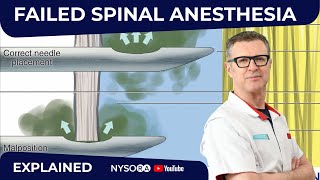 Failed Spinal Anesthesia Explained 1  Regional anesthesia Crash course with Dr Hadzic [upl. by Neala]