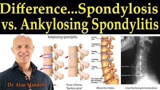 The Difference Between Spondylosis amp Ankylosing Spondylitis  Dr Alan Mandell DC [upl. by Eniotna856]